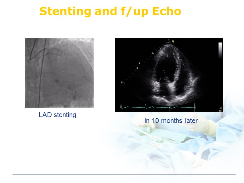 Stenting and f/up Echo in 10 months later LAD stenting